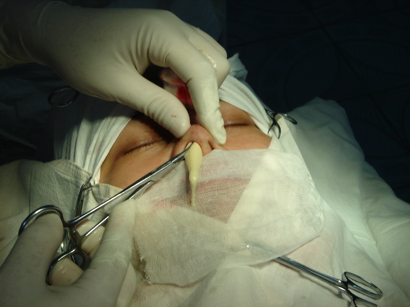 看看隆鼻美容手术的过程(图片可能引起你的不