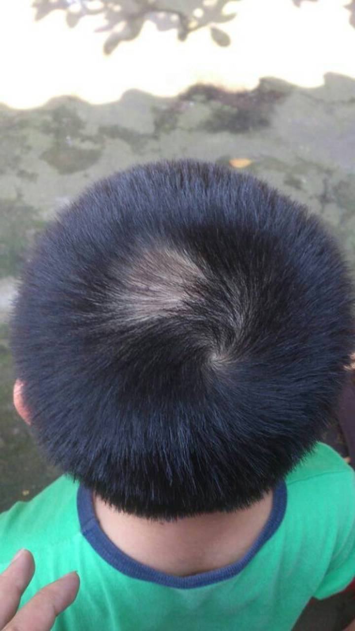 专治斑秃(鬼剃头),祖传秘方,治好收费,一个月见