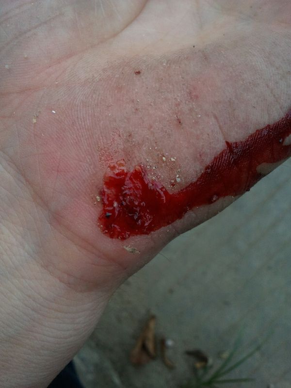 左手深度擦伤!