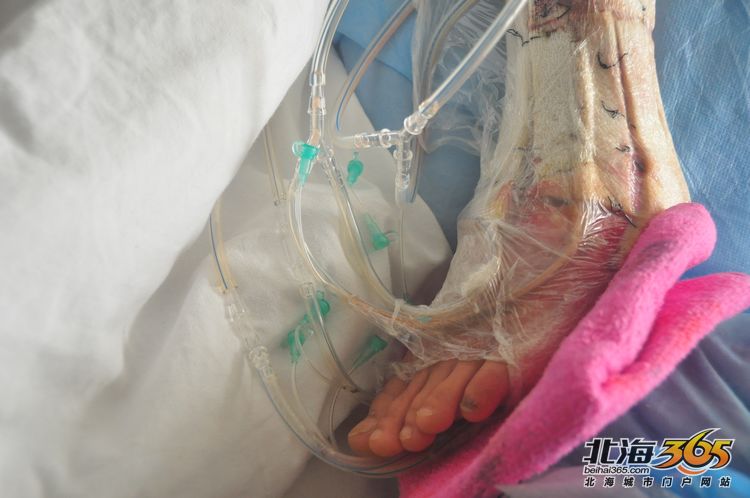 合浦沙田中学一名学生被货运汽车两次碾压小腿断骨(图片可能引起不适)