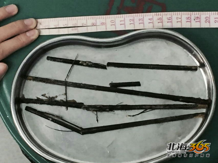 钟某胃里取出来的四根筷子,在取出的过程中折断了