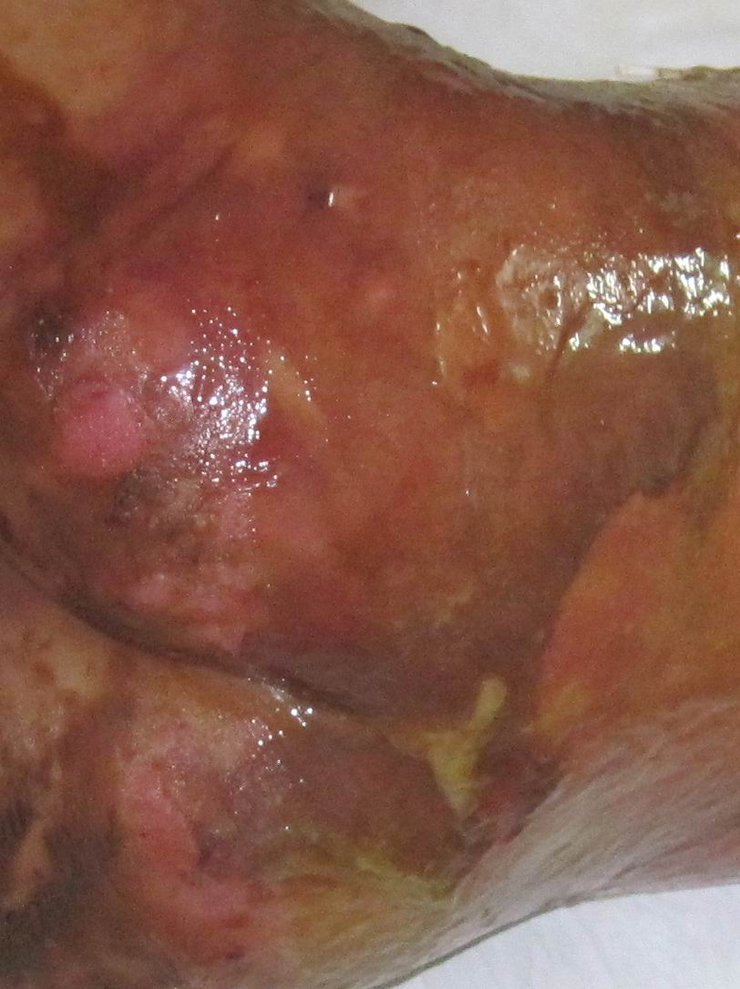 被烫伤小女孩的近况