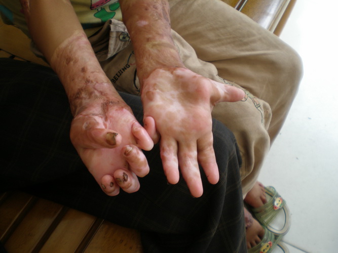 姐姐右手手指卷缩,不能伸张.右手无法使用,已经残废了