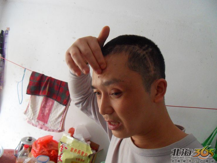 在北海建筑工地被砸"脑浆喷出"的农民工——唐小华,终于拿到赔偿判决