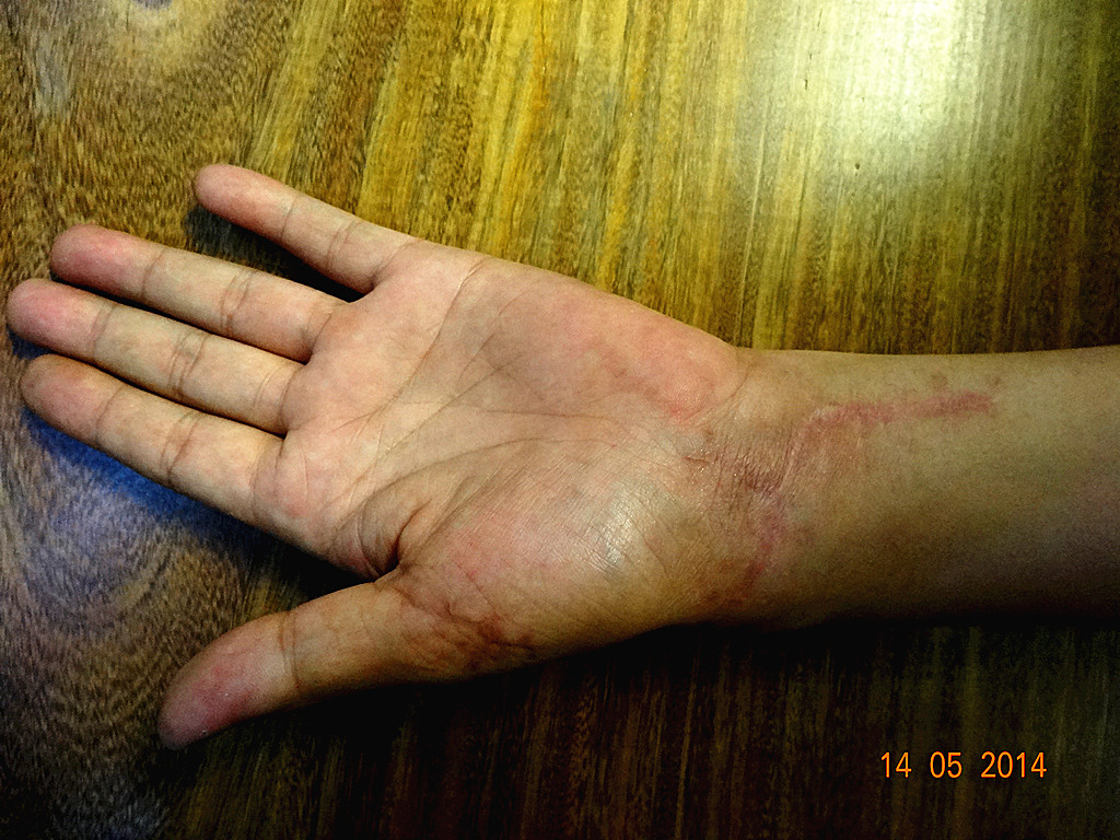 伤情       手掌及鼻尖的刀伤已基本恢复,但手掌中的钢钉还没有瘸出