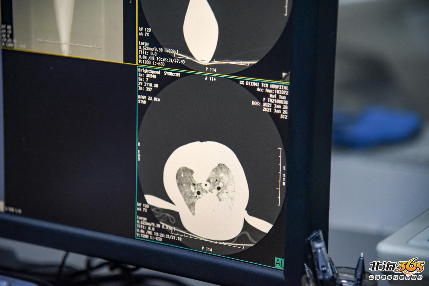 全程实录一头江豚在北海做ct我们可能是历史第一批见证的人