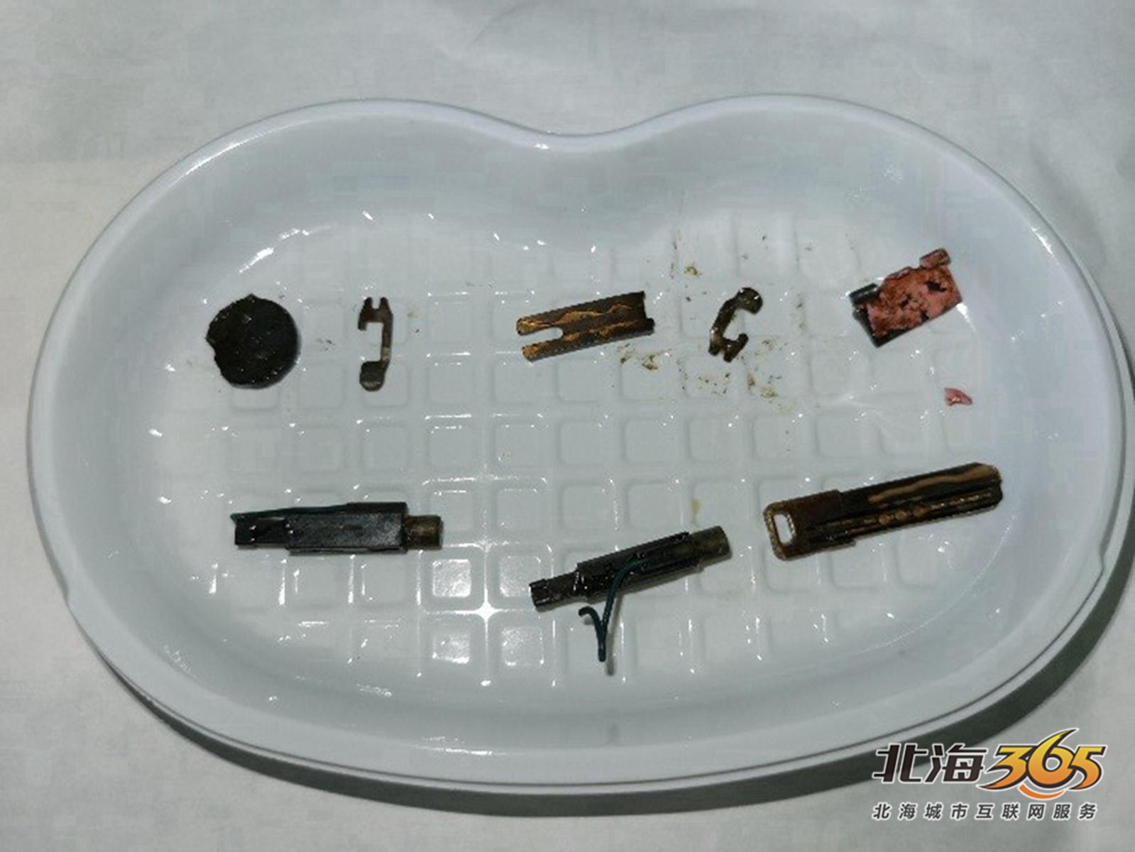 饮醉了!30岁男人吞下打火机,钥匙,铁片...!2天后肚痛才去医院-北海时