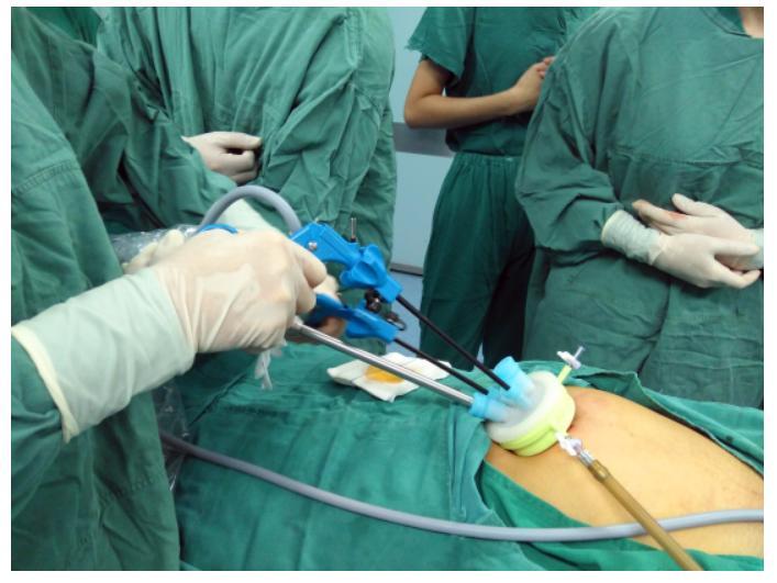 14岁女孩肚子变大检查却发现巨大肿瘤