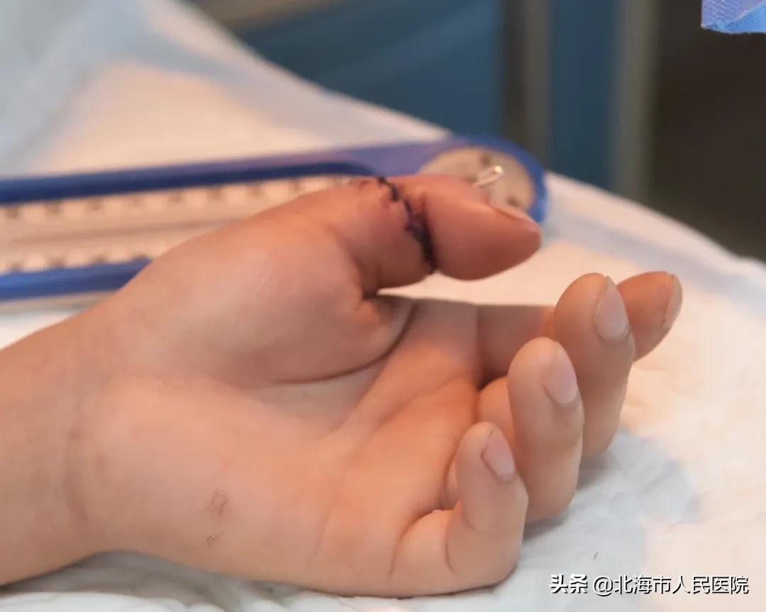 神奇!29岁男人锯断大拇指,北海人民医院花6小时给他接回来了