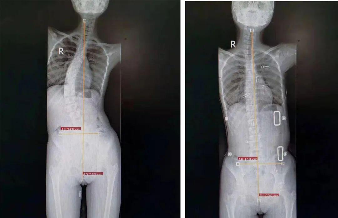 3年前,北海13岁女孩脊柱竟弯成了c字型