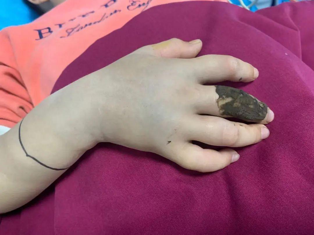 手指都黑了,合浦小学生被竹叶青咬伤中指